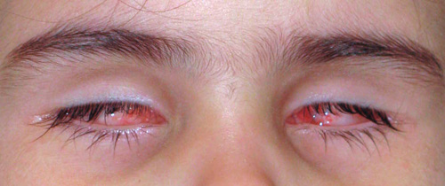 Bilateral Retinoblastoma Dalpasso Protesi Oculari